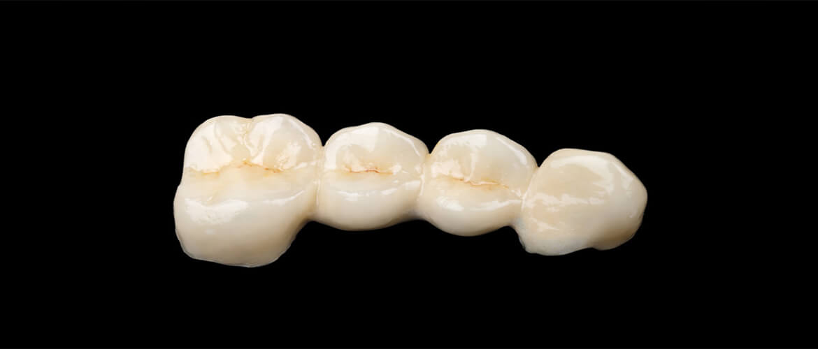 Bridge to protect teeth from fracture and/or replace missing teeth
