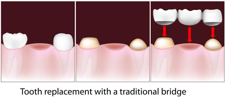 Tooth replacement with a traditional bridge