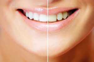 Tooth whitening before & after picture