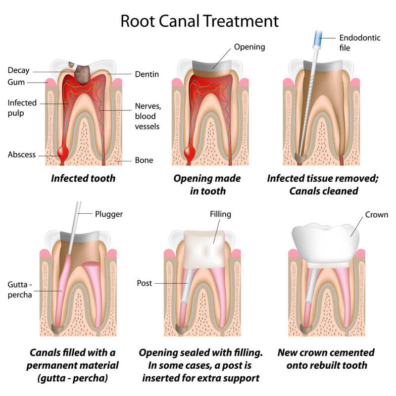 Root Canal Treatment procedure example